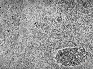 M,2m. | undefined hereditary syndrome, multiplied anomalies, sibling Bcornea - keratopathy … missing Bowman membrane, disorganized stromal architecture M,2m. | undefined hereditary syndrome, multiplied anomalies, sibling Bcornea - keratopathy … missing Bowman membrane, disorganized stromal architecture